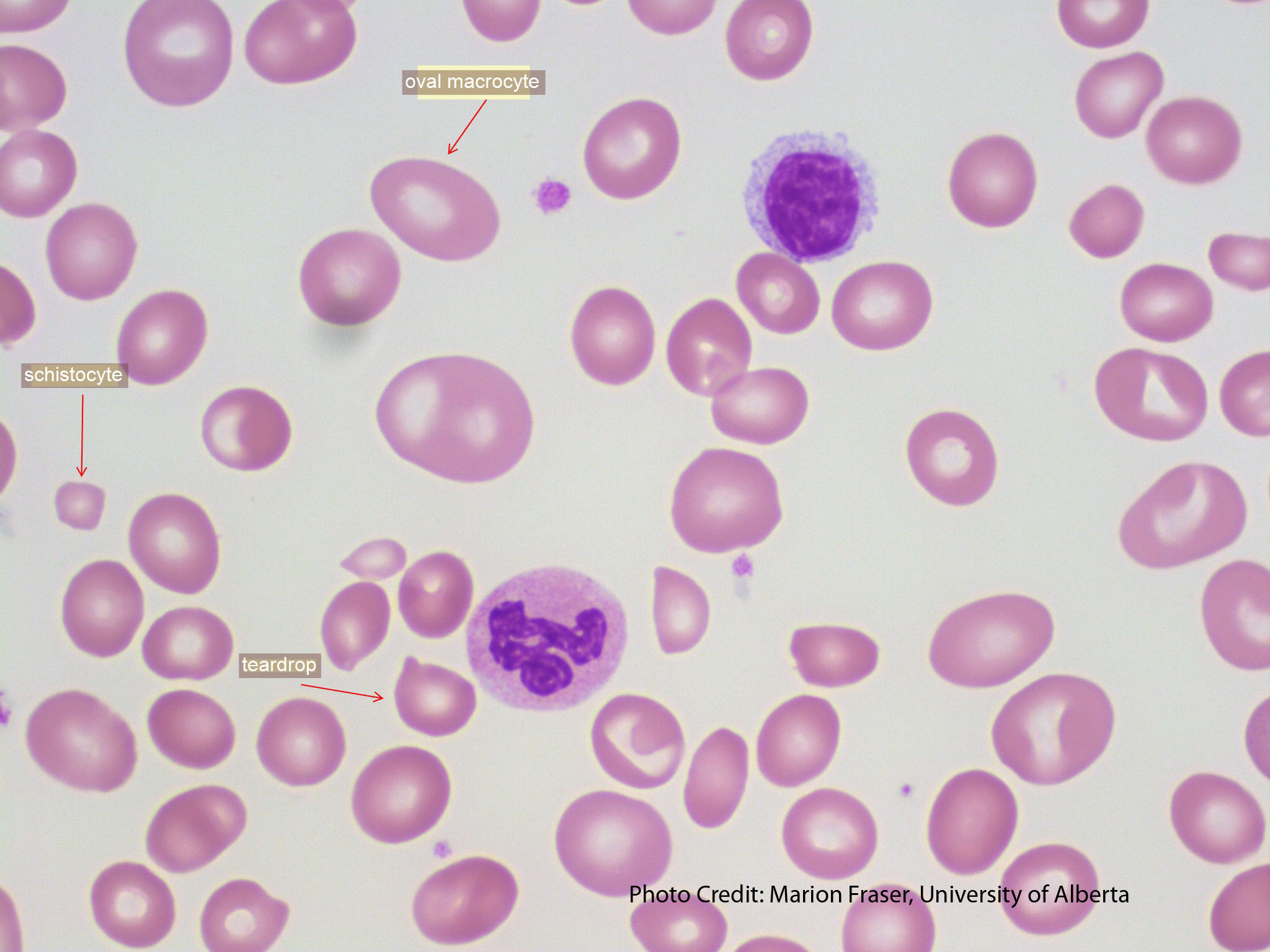 megaloblastic anemia